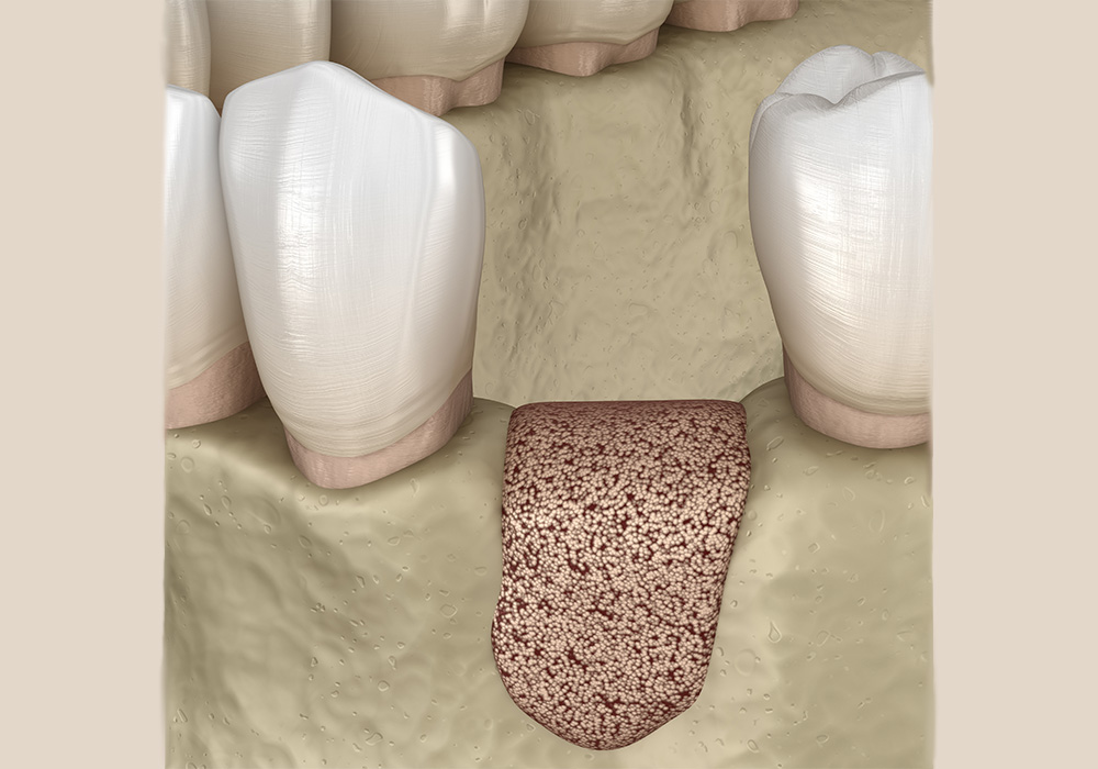 顎の骨が不足している場合にも対応